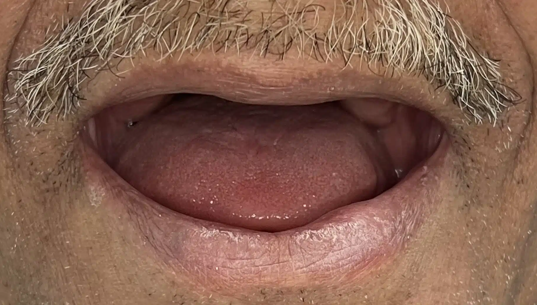 Smile Gallery | Real Patient Results at The Denture Place Tampa