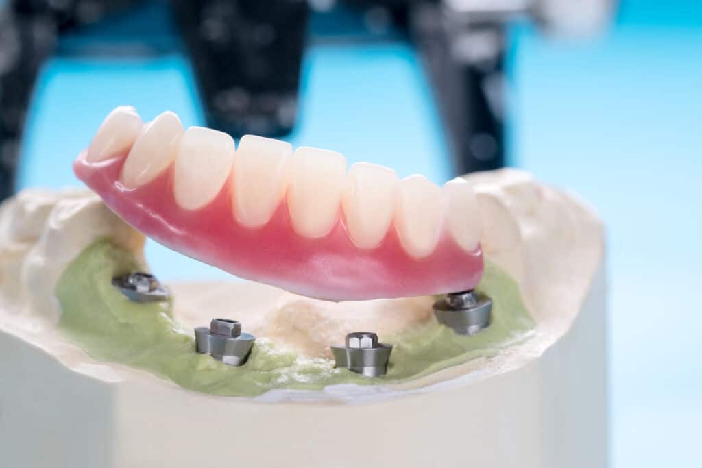 Implant-Supported Dentures near me